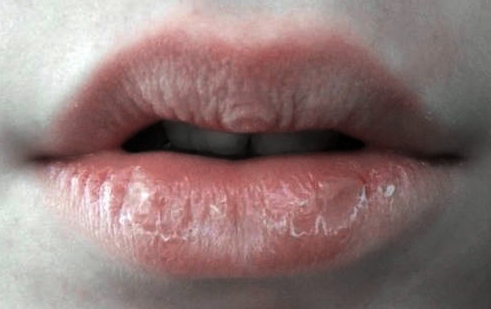 Obat Alami Bibir Pecah-Pecah