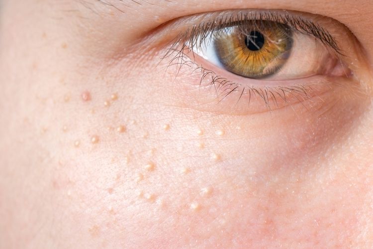 Cara Menghilangkan Milia Menggunakan Bahan Alami