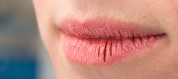 Cara Mudah Untuk Merawat Bibir Pecah-Pecah